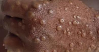 Guinée : 7 cas de Mpox confirmés et quatre maladies sous surveillance, selon l’Agence Nationale de Sécurité Sanitaire